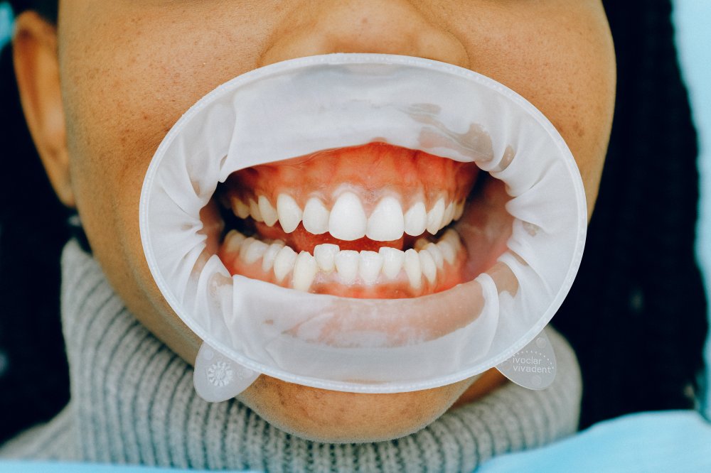 Gum Disease: What Causes It and How Can You Treat It?